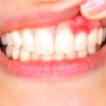 Gum Disease Prevention: Top Tips for Healthy Gums