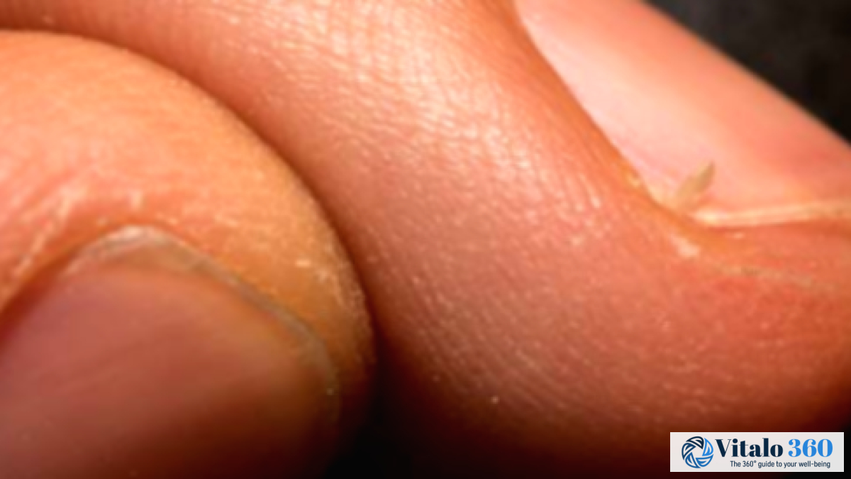Hangnail Help: Causes & Simple Home Treatments