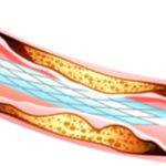 Heart Catheterization: Benefits and Key Risk Factors Heart Catheterization: Benefits and Key Risk Factors