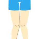 Knock Knees: Symptoms, Causes, and Treatment Options Knock Knees: Symptoms, Causes, and Treatment Options