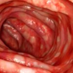 Left-Sided Colitis: Symptoms, Causes, & Treatment