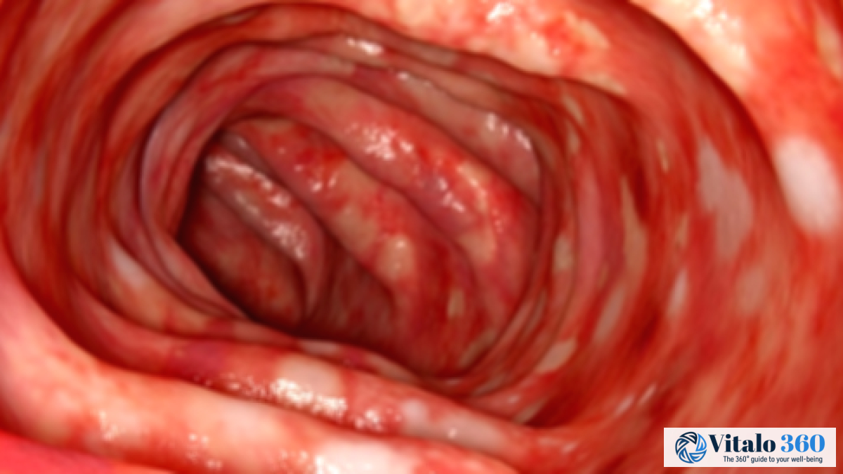 Left-Sided Colitis: Symptoms, Causes, & Treatment Left-Sided Colitis: Symptoms, Causes, & Treatment