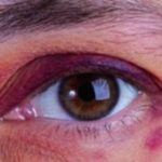 Raccoon Eyes: Understanding This Unusual Symptom