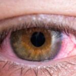 Red Eyes: Your Comprehensive Guide & Causes Red Eyes: Your Comprehensive Guide & Causes