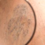 Sclerotherapy for Varicose Veins: Key Facts You Should Know Sclerotherapy for Varicose Veins: Key Facts You Should Know