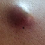 Sebaceous Cyst: Causes, Symptoms, and Treatment Options
