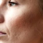 Shrink Pores: Effective Tips for Smoother Skin