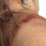 Skin Grafting: What Is It and How Is It Done?