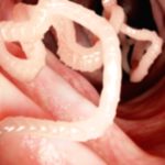 Tapeworm Infection: Key Facts & Prevention Tips