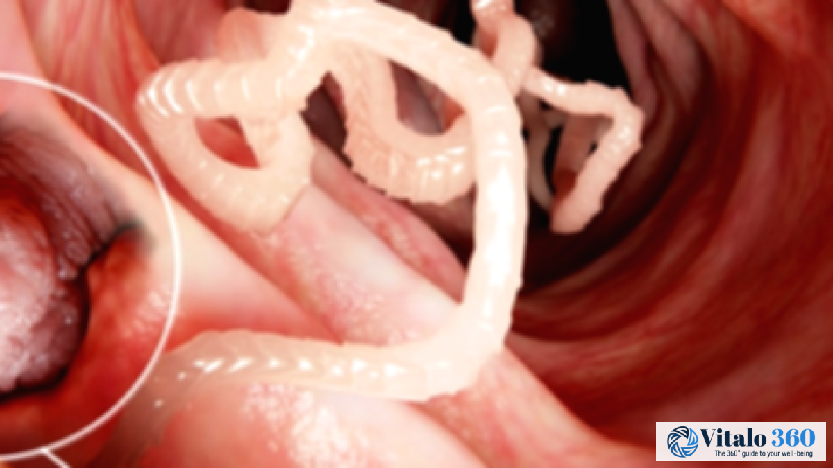 Tapeworm Infection: Key Facts & Prevention Tips