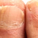 Thick Nails: Causes and Effective Treatment Options Thick Nails: Causes and Effective Treatment Options