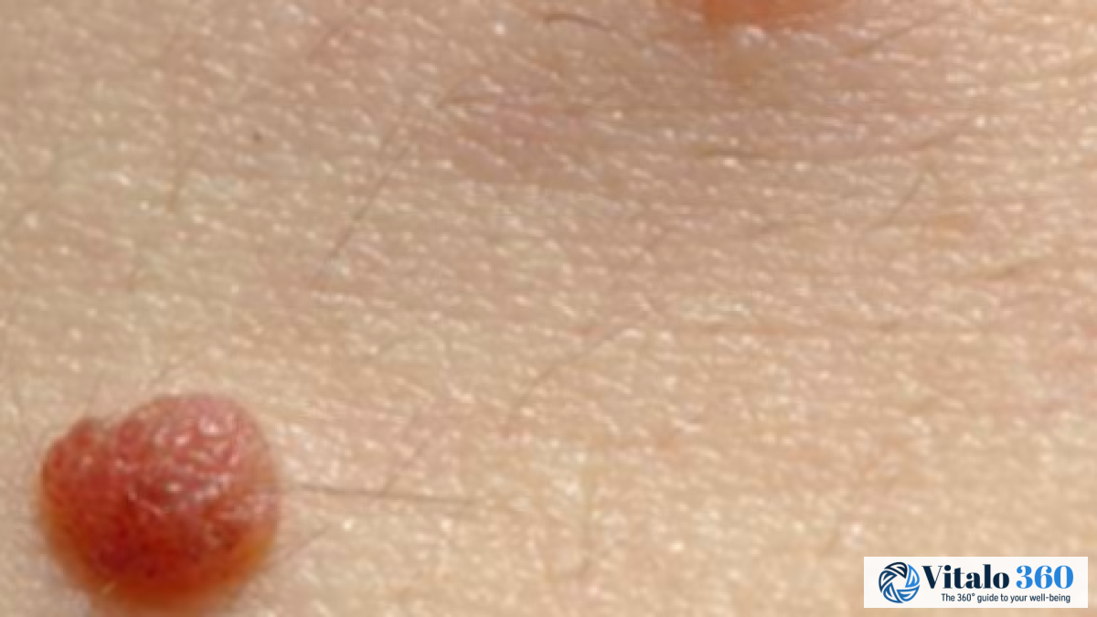 Third Nipple: Is Having One Normal? A Quick Guide