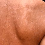 Tinea Versicolor: Causes, Symptoms, and Effective Treatments