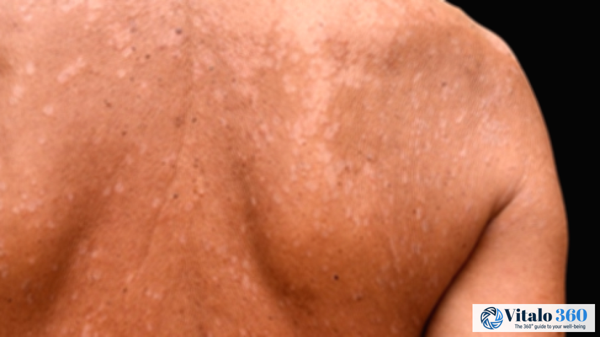 Tinea Versicolor: Causes, Symptoms, and Effective Treatments