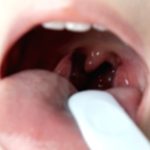 Tonsillitis Guide: Symptoms, Causes, & Treatment Options