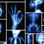 X-Rays: Balancing the Benefits and Potential Risks X-Rays: Balancing the Benefits and Potential Risks