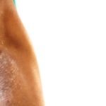 Acanthosis Nigricans: Causes, Symptoms, and Treatments Acanthosis Nigricans: Causes, Symptoms, and Treatments