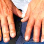 Frostbite: What Happens & How to Avoid It Frostbite: What Happens & How to Avoid It