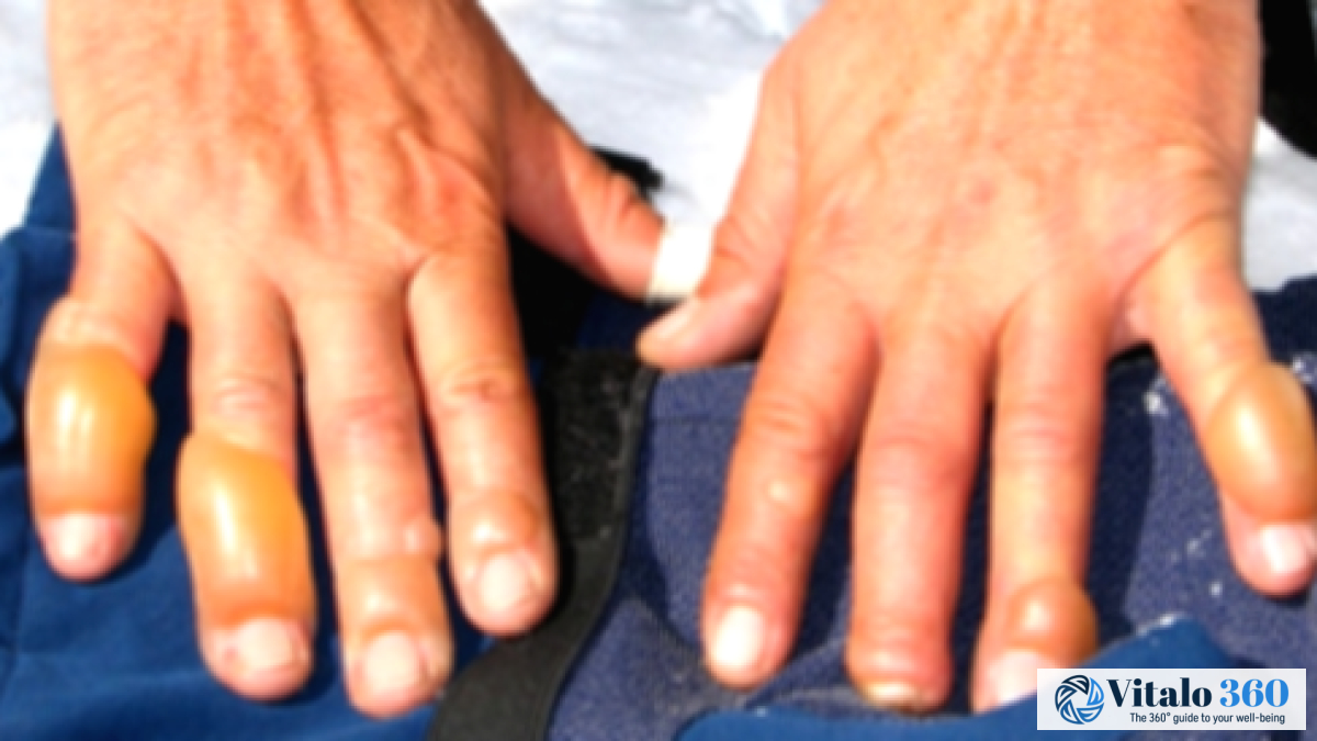 Frostbite: What Happens & How to Avoid It Frostbite: What Happens & How to Avoid It