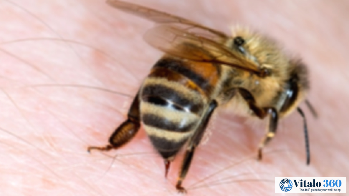 Natural Home Remedies for Bee Sting Relief