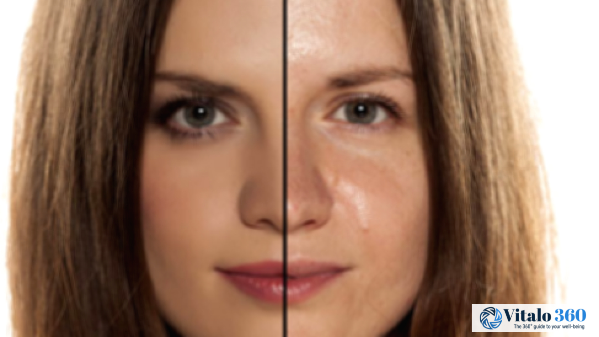 Natural Remedies to Reduce Oily Nose Skin