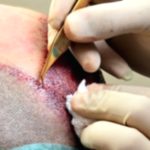 No-Shave Hair Transplant: A Cutting-Edge Technique No-Shave Hair Transplant: A Cutting-Edge Technique