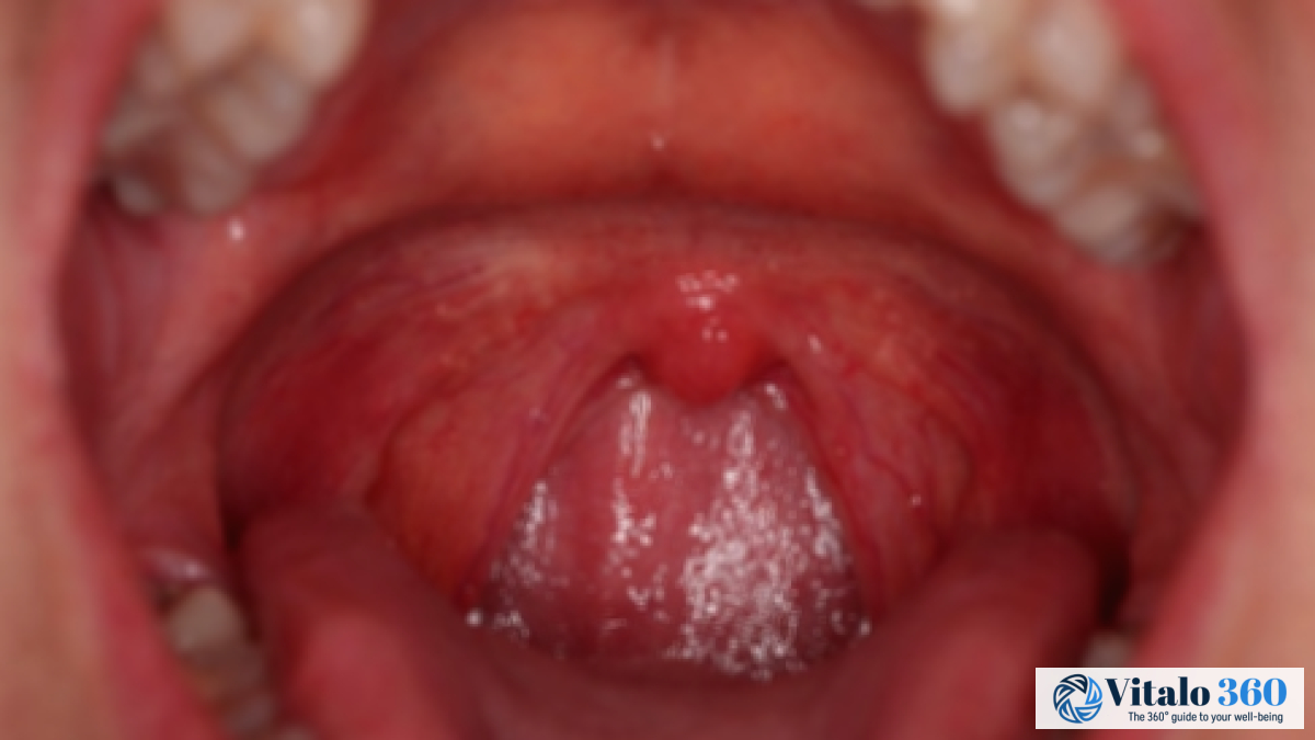 Sore Throat Relief: Simple Remedies & Natural Recipes